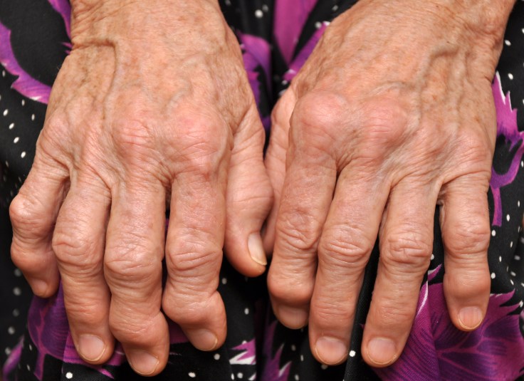 Home Remedies For&nbsp;Arthritis
