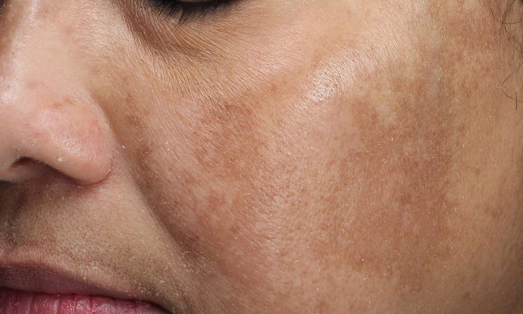 7 Natural Ways To Fade Facial Dark Spots