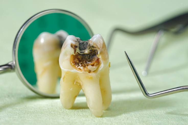 7 Foods That Can Help Stop Tooth&nbsp;Cavities